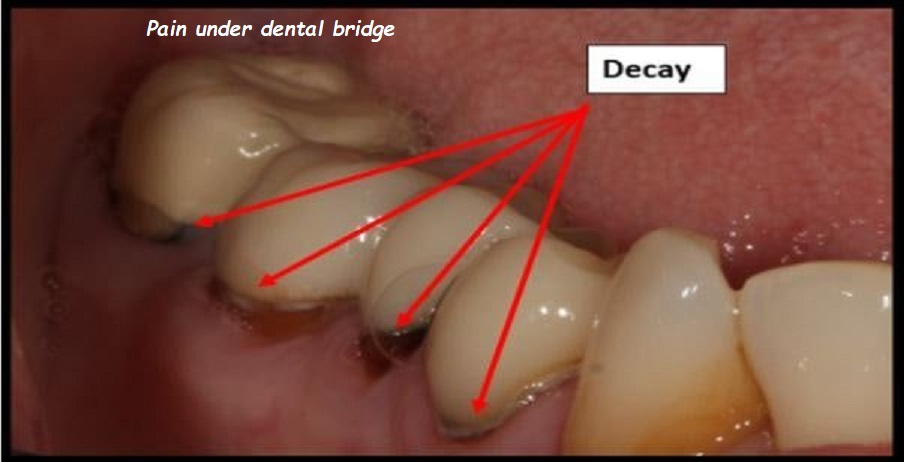 pain under dental bridge