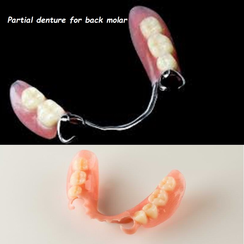 Partial denture for back molar