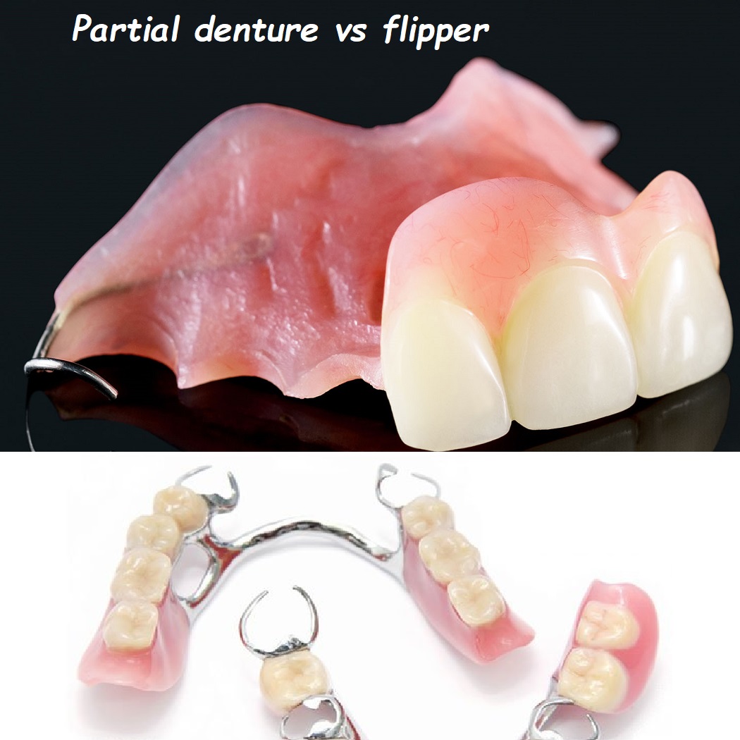 Partial denture vs flipper