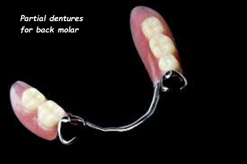 partial dentures for back molar