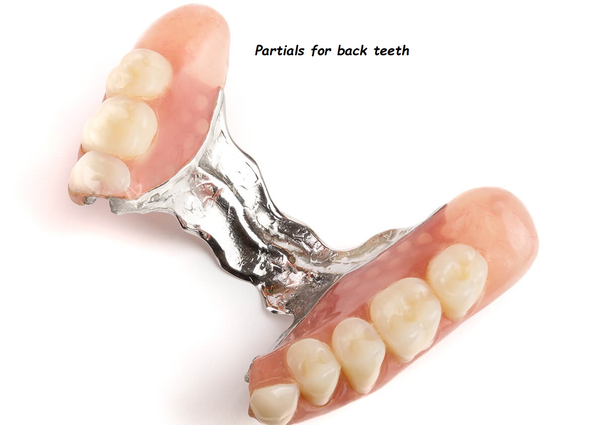 Partials for back teeth