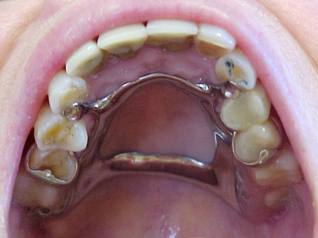 Partials for back teeth