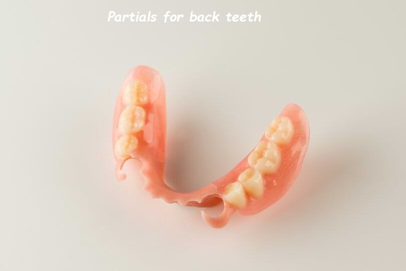 Partials for back teeth