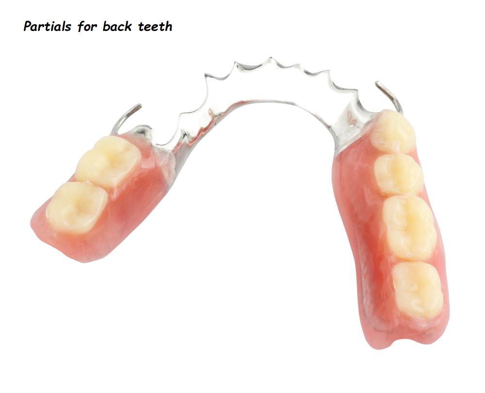 Partials for back teeth