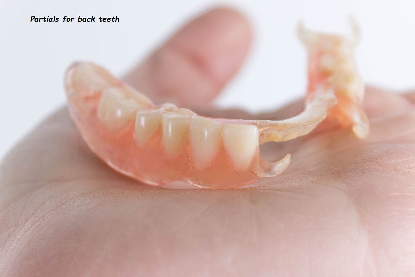 Partials for back teeth