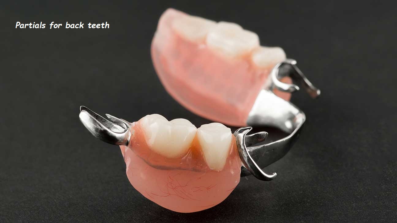 partials for back teeth