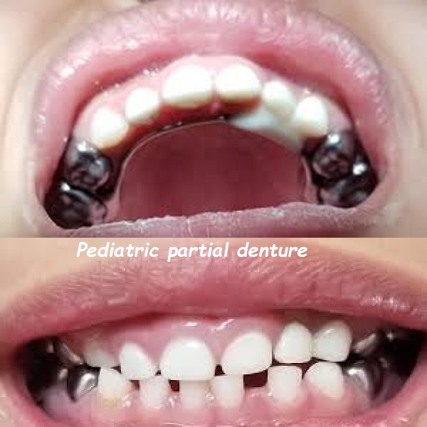 Pediatric partial denture