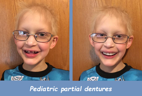 Pediatric partial dentures