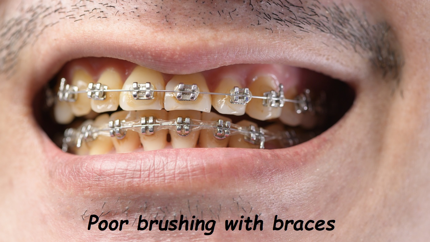 Poor brushing with braces