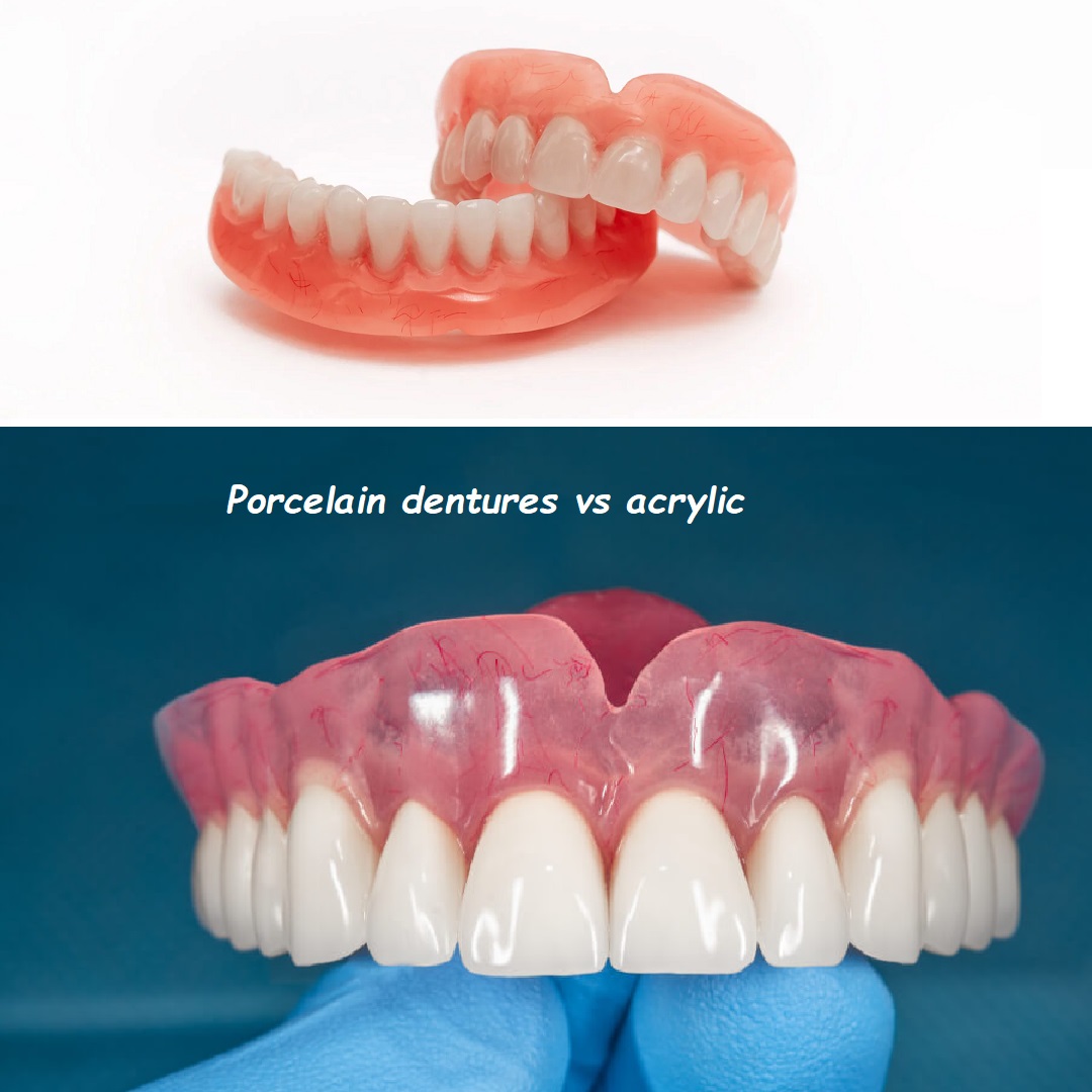 Porcelain dentures vs acrylic