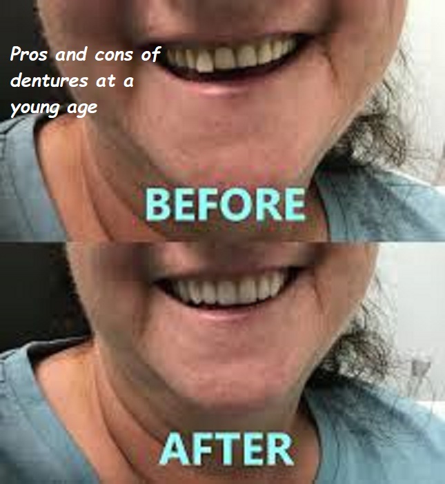 Pros and cons of dentures at a young age