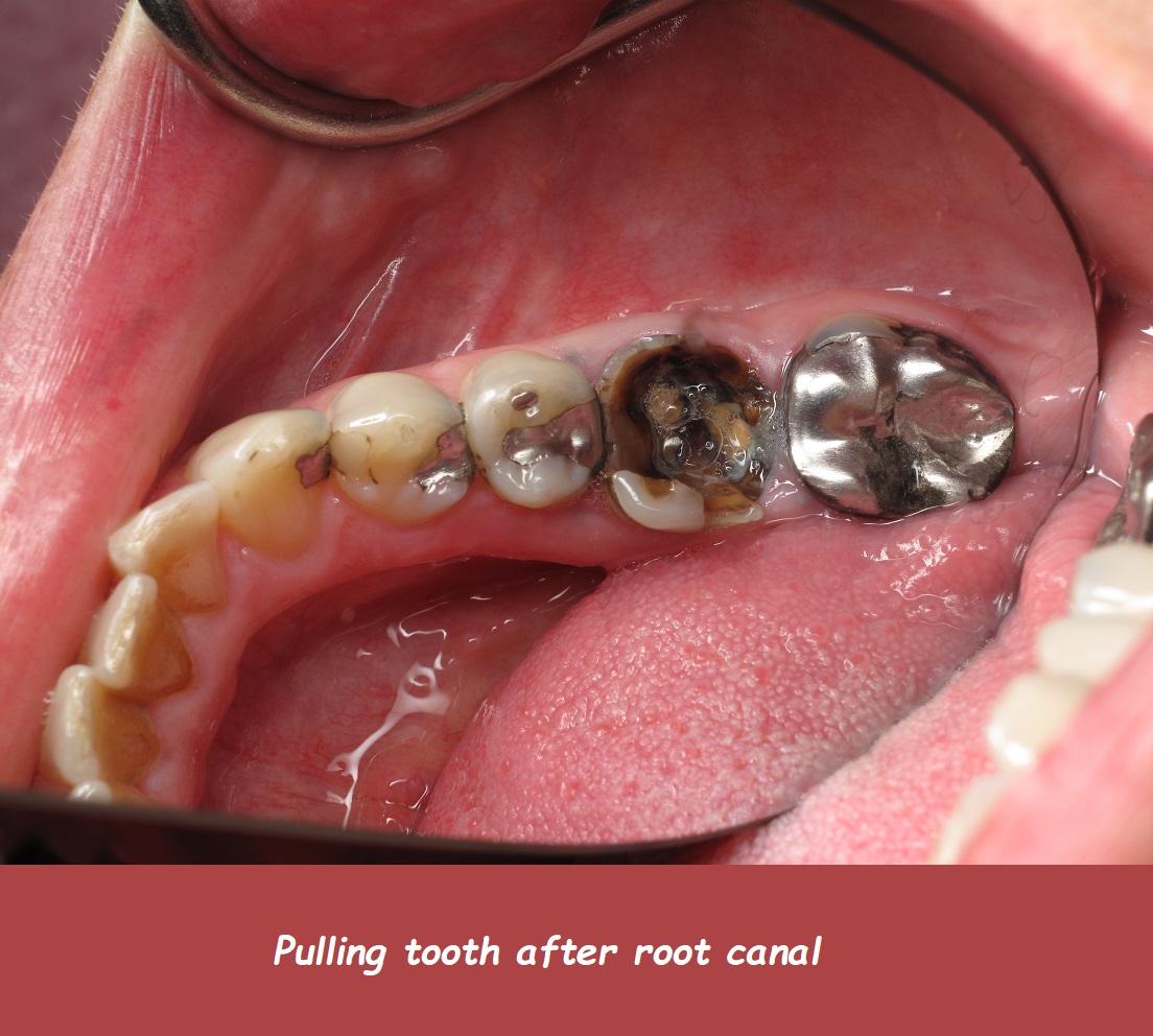 pulling tooth after root canal