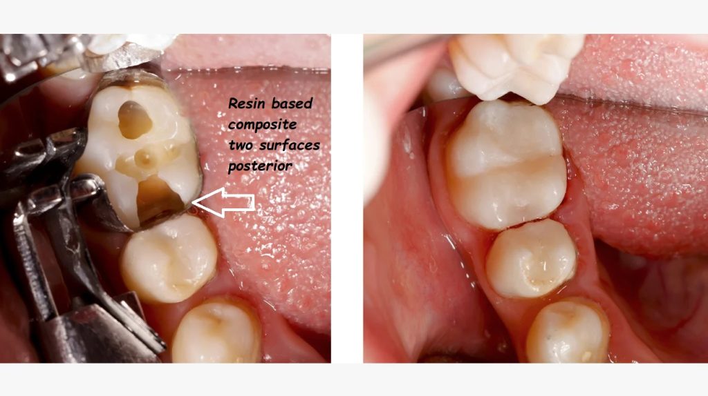 resin based composite two surfaces posterior