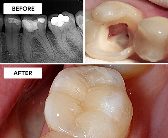 root canal same day