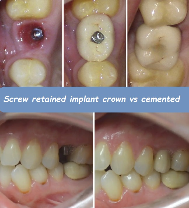 Screw retained implant crown vs cemented