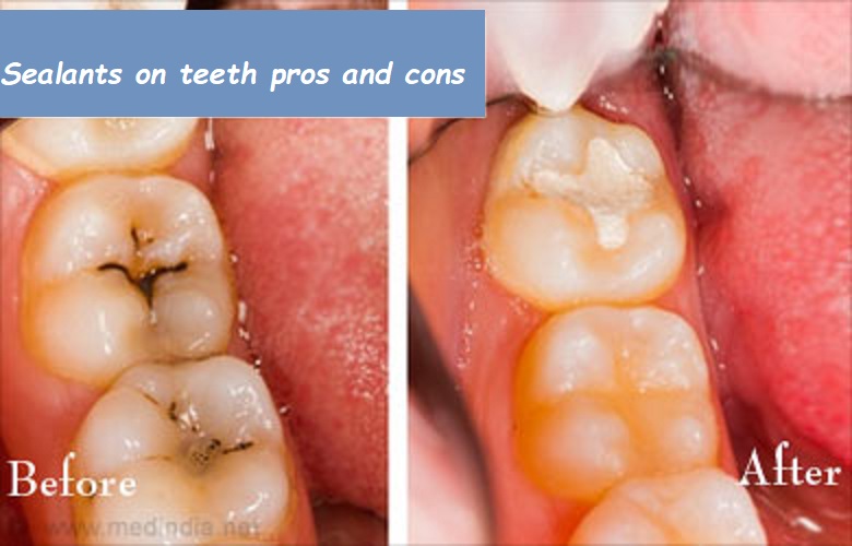 sealants on teeth pros and cons