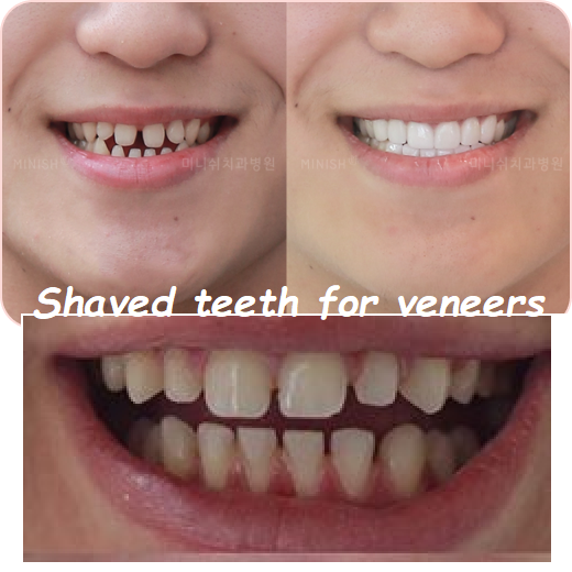 Shaved teeth for veneers