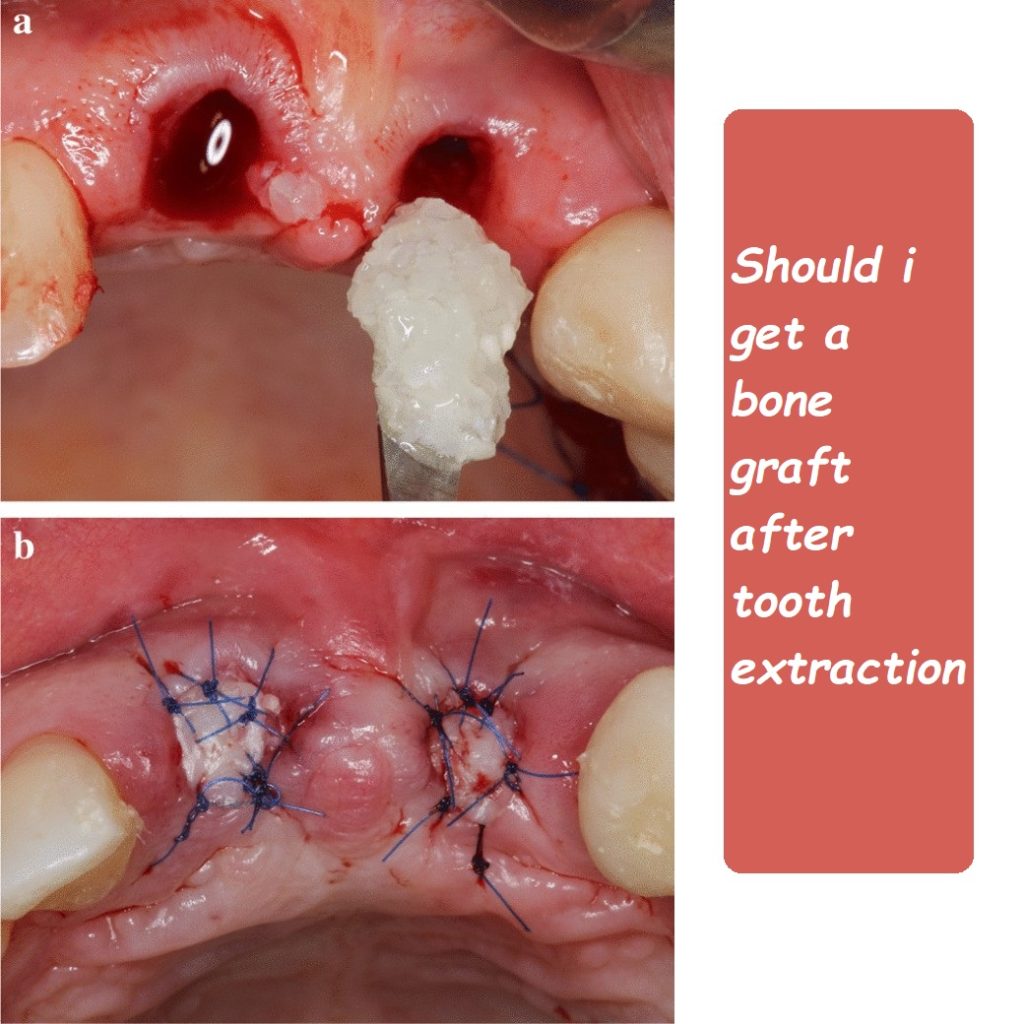 Should i get a bone graft after tooth extraction