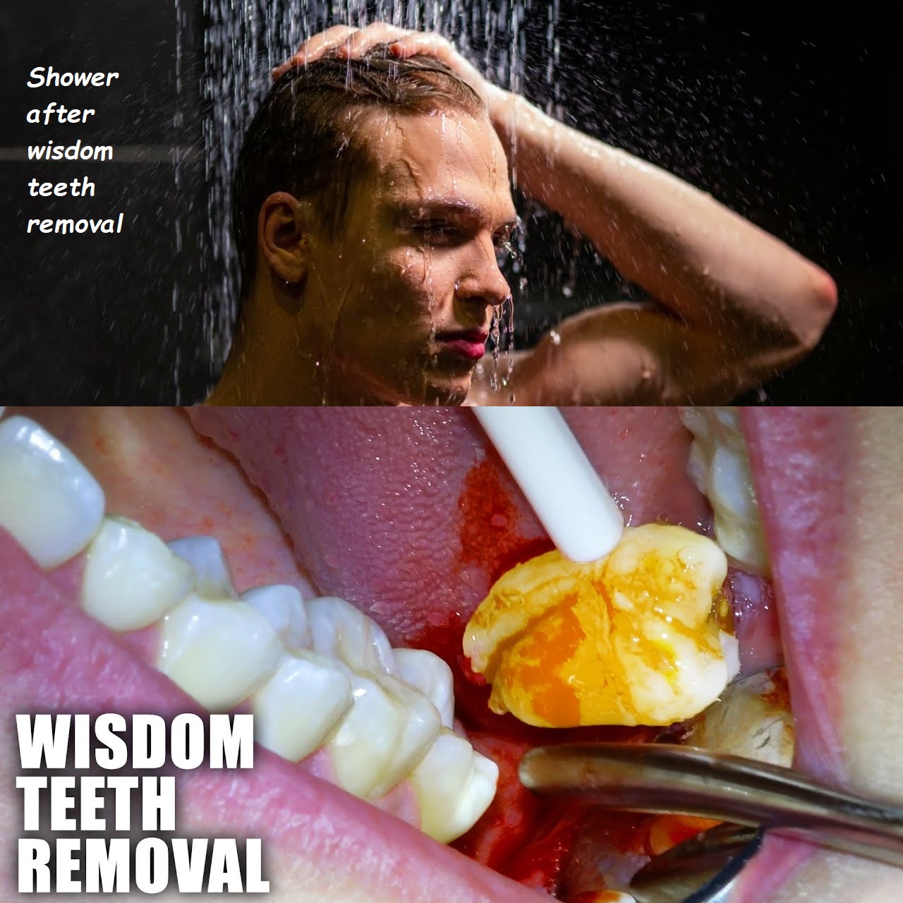 Shower after wisdom teeth removal