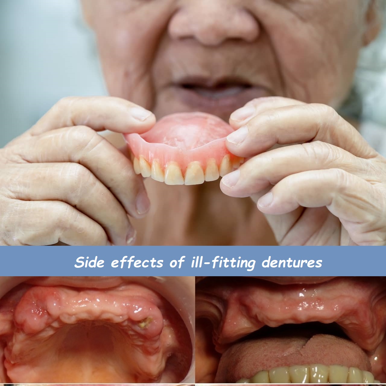 Side effects of ill-fitting dentures