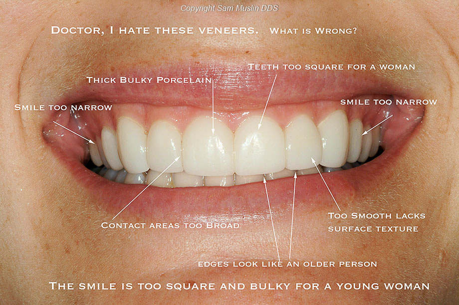 Signs of Bad Veneers