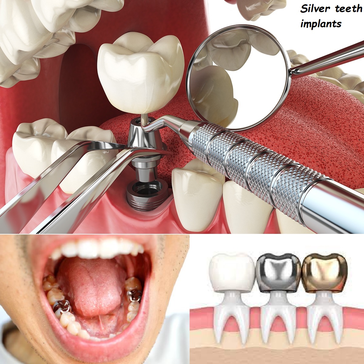 Silver teeth implants