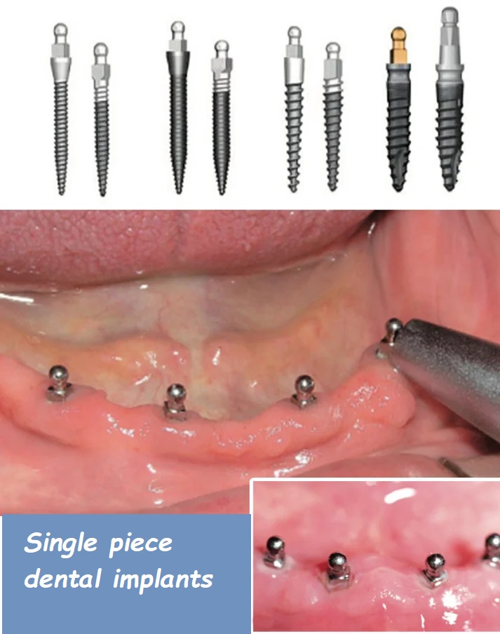 single piece dental implants