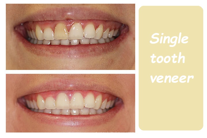 Single tooth veneer