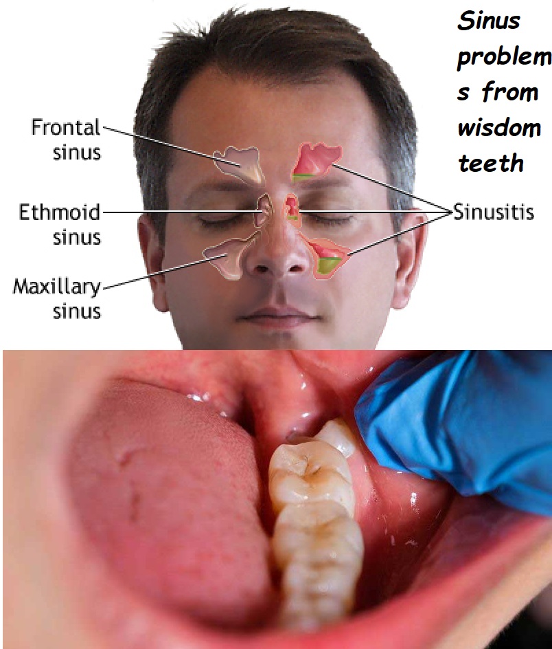 Sinus problems from wisdom teeth