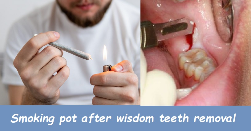 Smoking pot after wisdom teeth removal