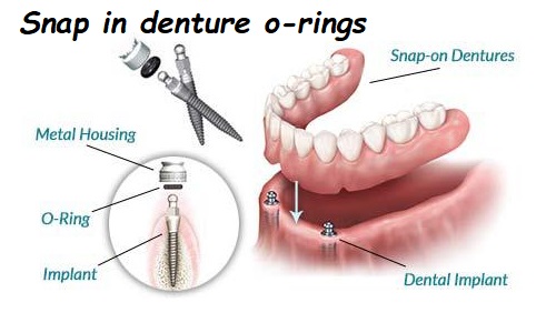 snap in denture o-rings