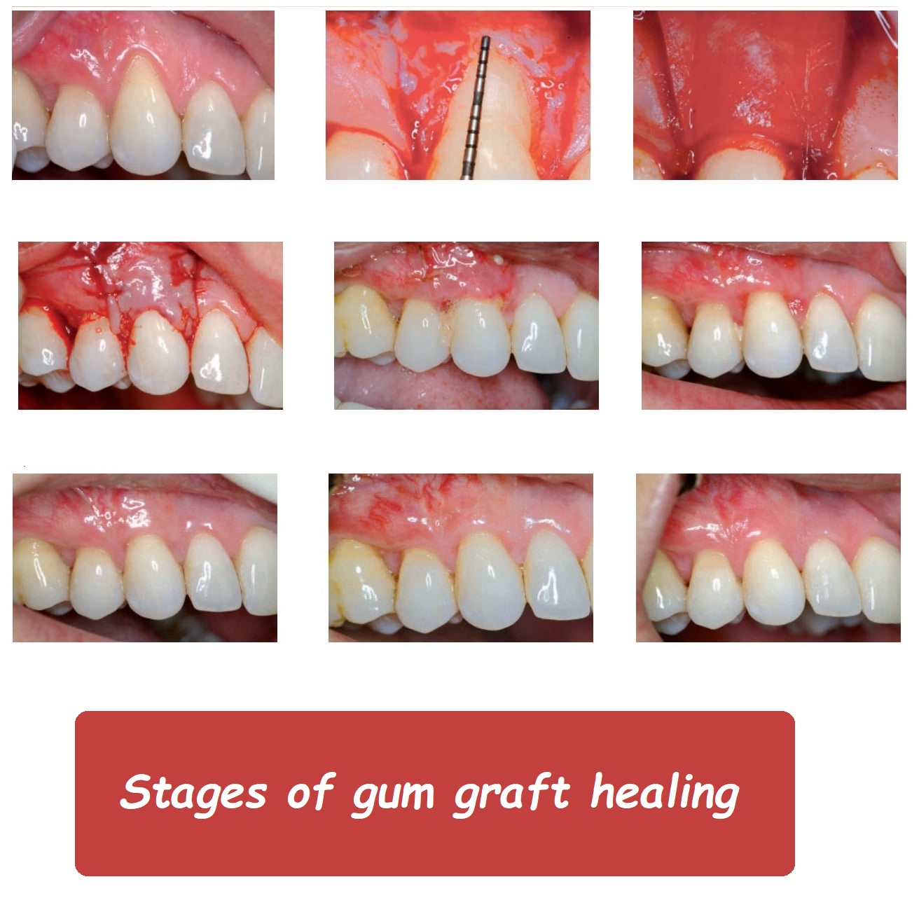 Stages of gum graft healing