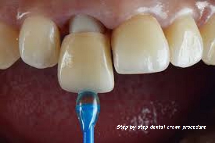 Step by step dental crown procedure