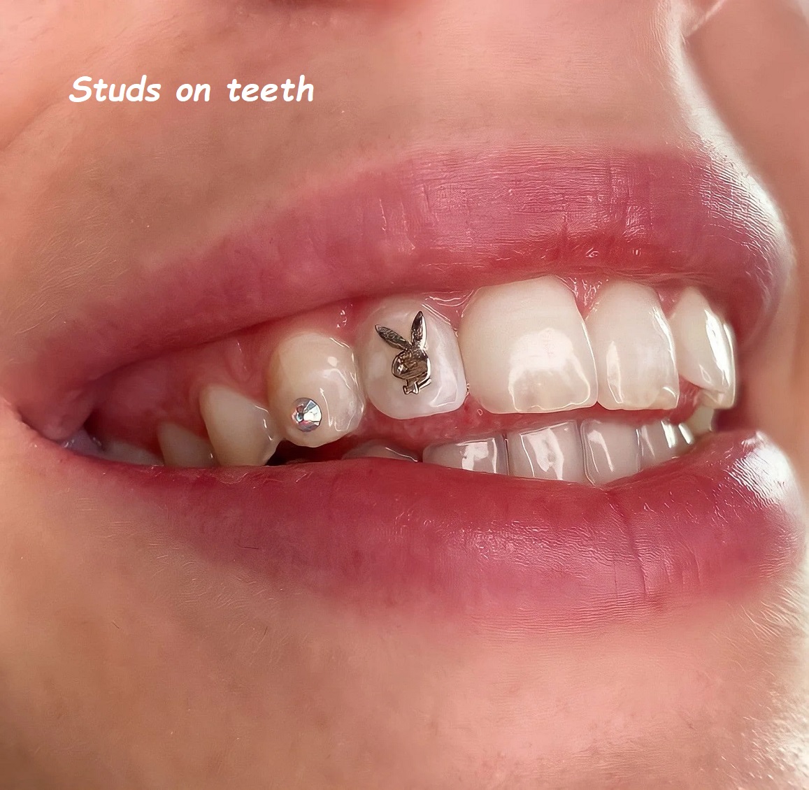 Studs on teeth