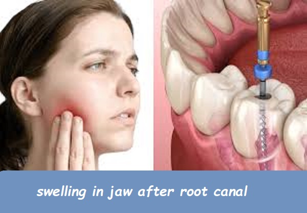 swelling in jaw after root canal