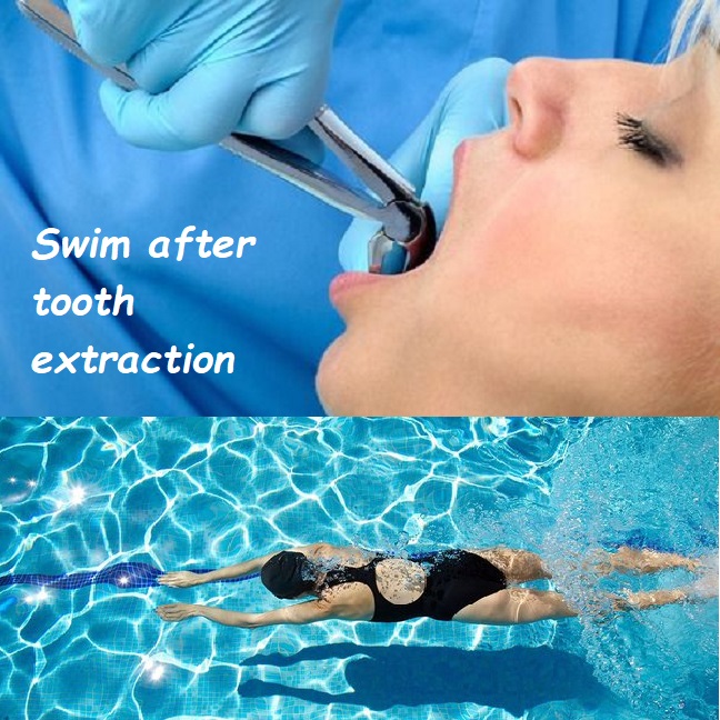 Swim after tooth extraction