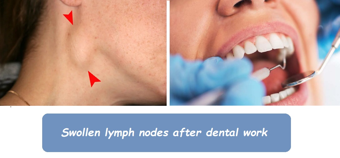 Swollen lymph nodes after dental work