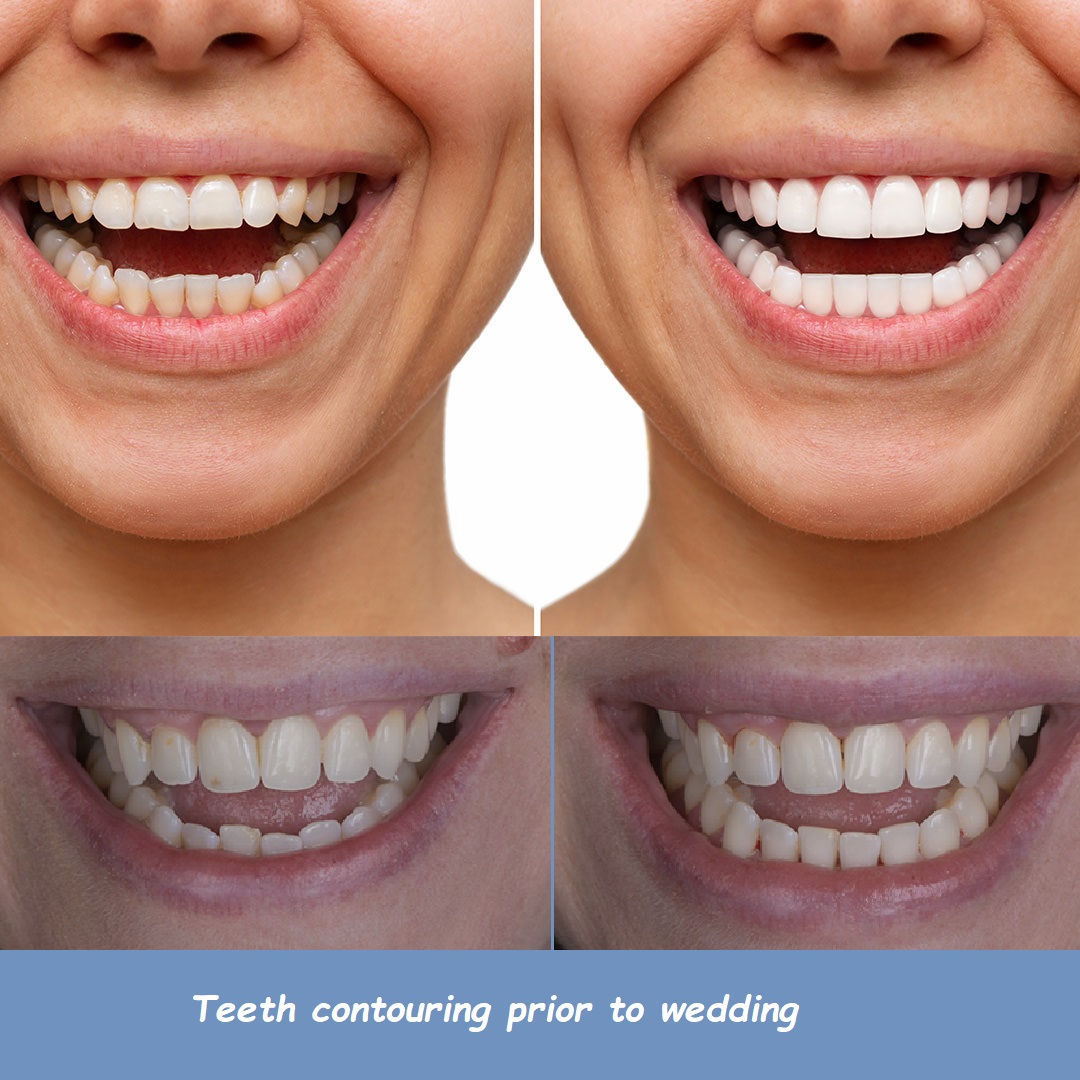 Teeth contouring prior to wedding