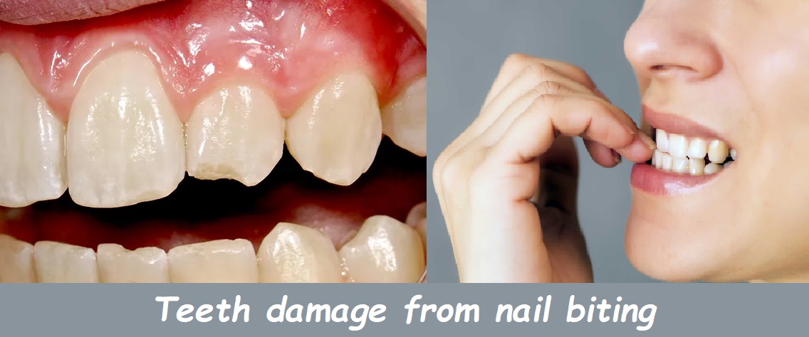 Teeth damage from nail biting