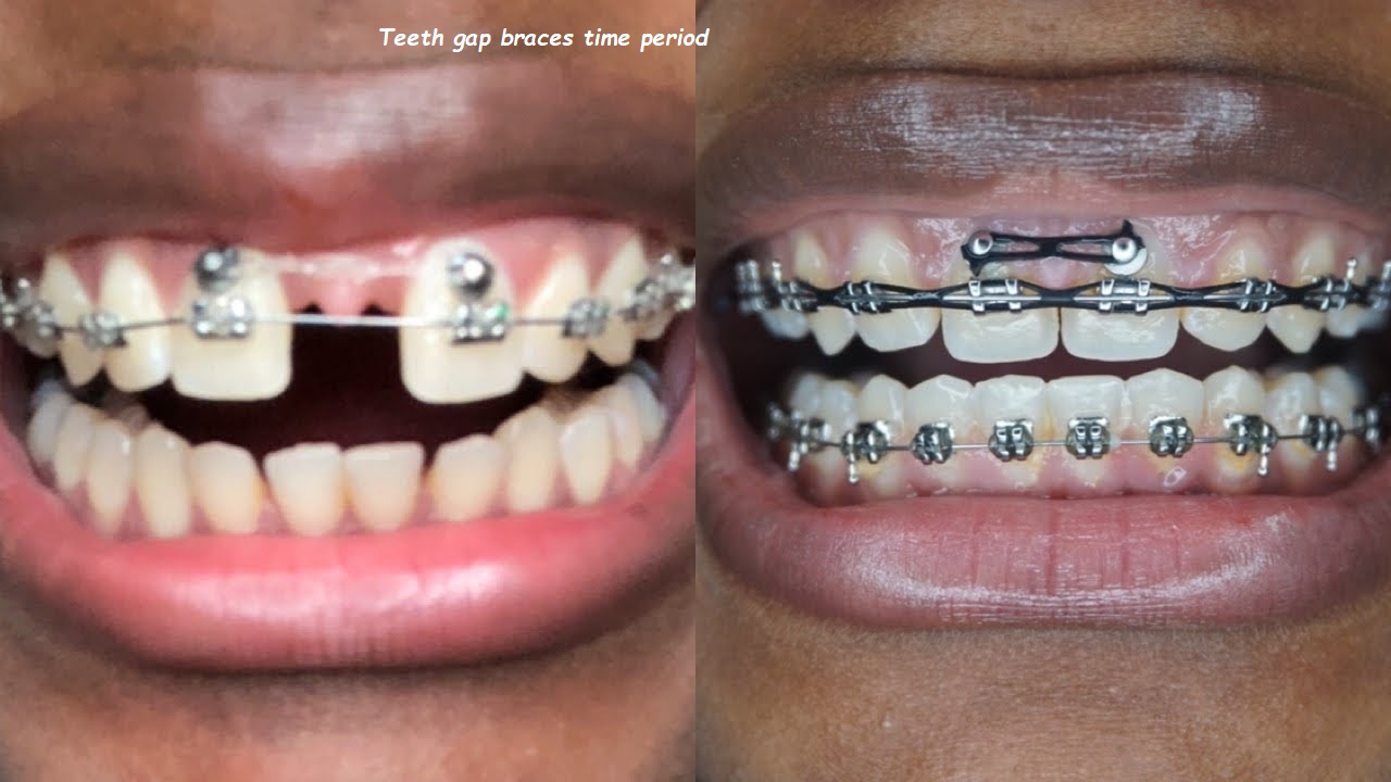 teeth gap braces time period