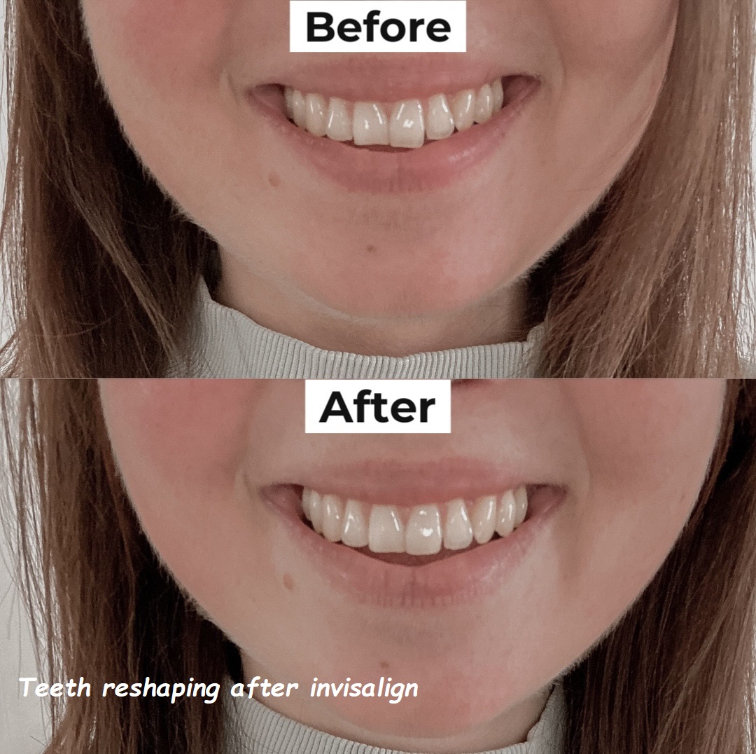 teeth reshaping after invisalign