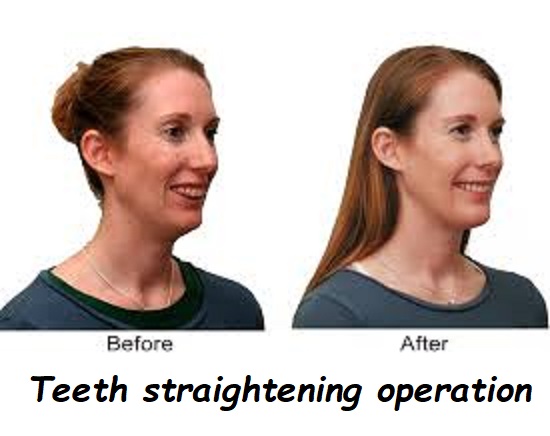 teeth straightening operation