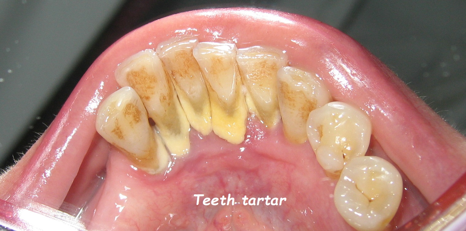 Teeth tartar