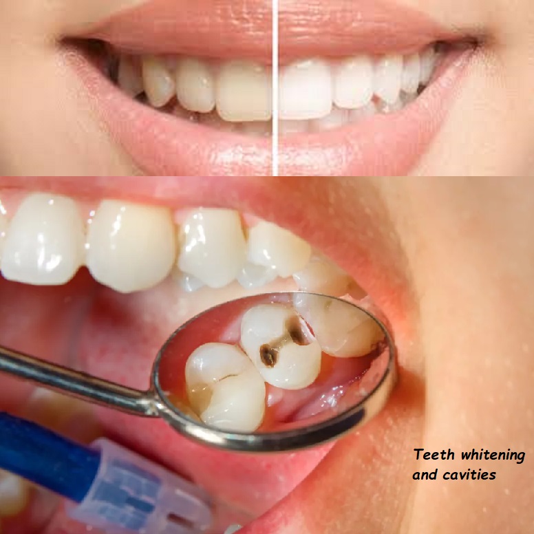 Teeth whitening and cavities