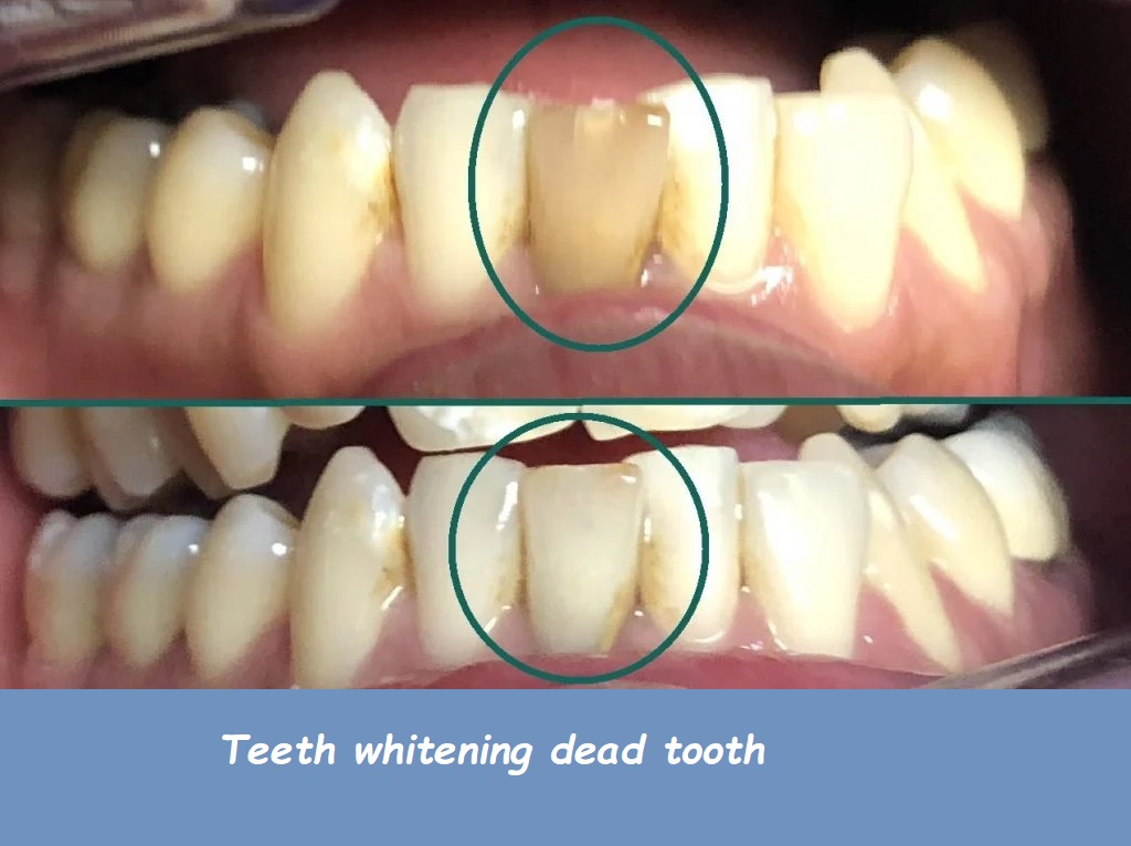 teeth whitening dead tooth