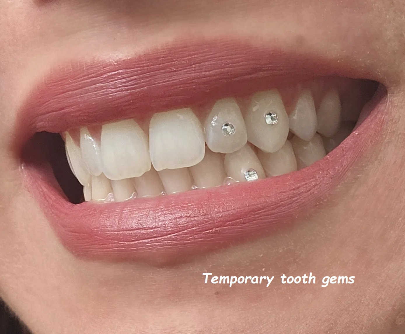 Temporary tooth gems