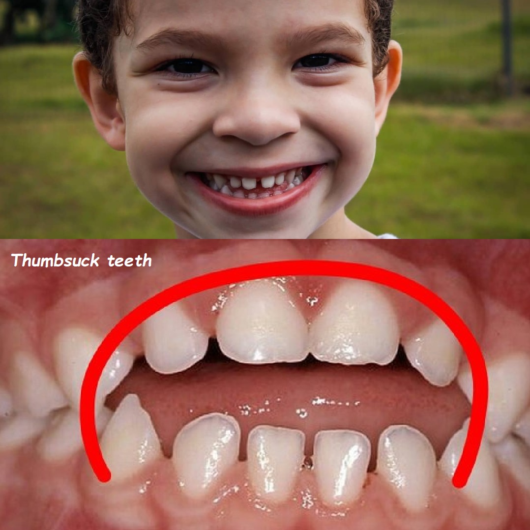 Thumbsuck teeth