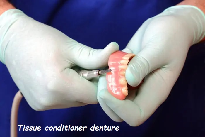 Tissue conditioner denture