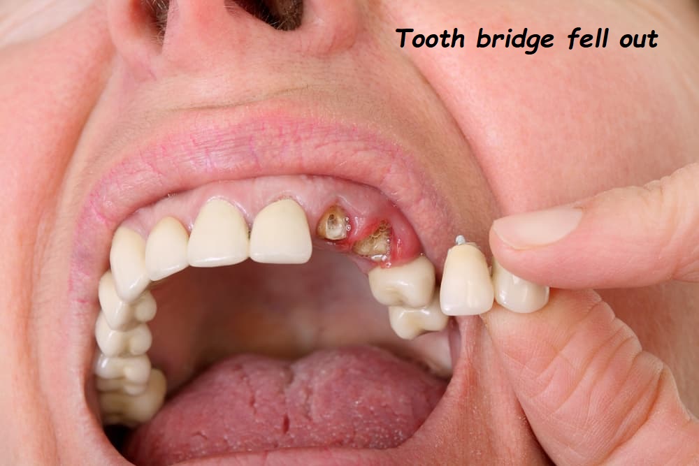 tooth bridge fell out