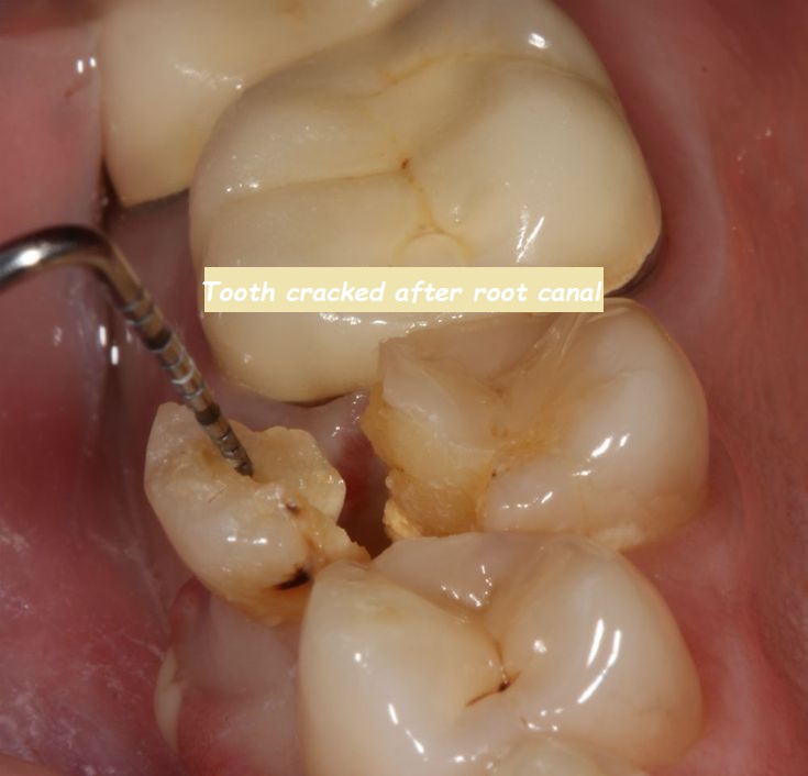 Tooth cracked after root canal